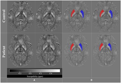 Iron quantification in basal ganglia using quantitative susceptibility mapping in a patient with ALS: a case report and literature review
